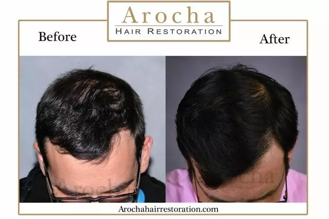 Arocha Hair Restoration