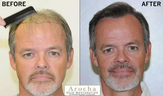 Arocha Hair Restoration