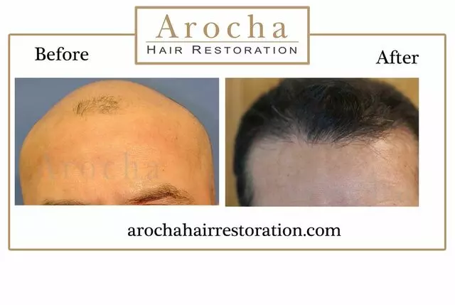 Arocha Hair Restoration