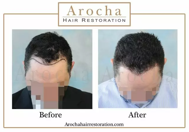 Arocha Hair Restoration