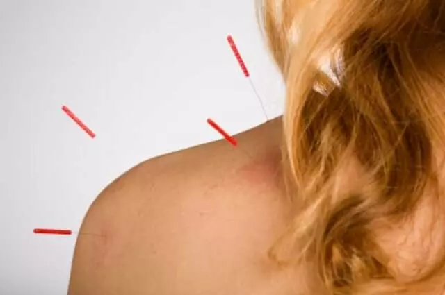 Austin Onsite Acupuncture