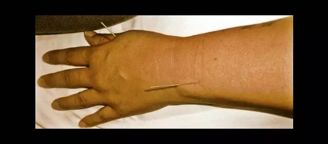 Acupuncture Plus