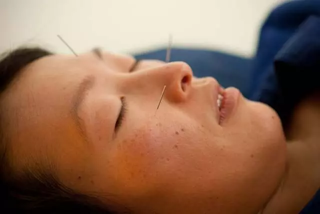 Acupuncture Together